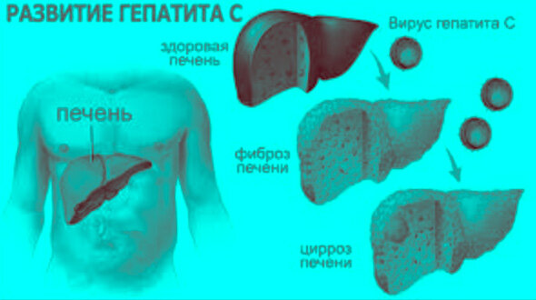 How to cure Hepatitis C - there was experience in curing chronic hepatitis C.jpg